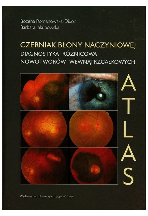 Czerniak błony naczyniowej Diagnostyka różnicowa nowotworów wewnątrzgałkowych