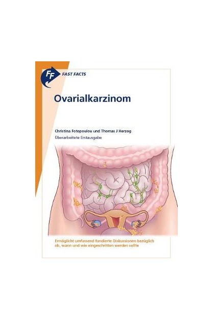 Fast Facts: Ovarialkarzinom