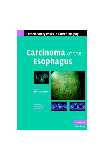 Carcinoma of the Esophagus