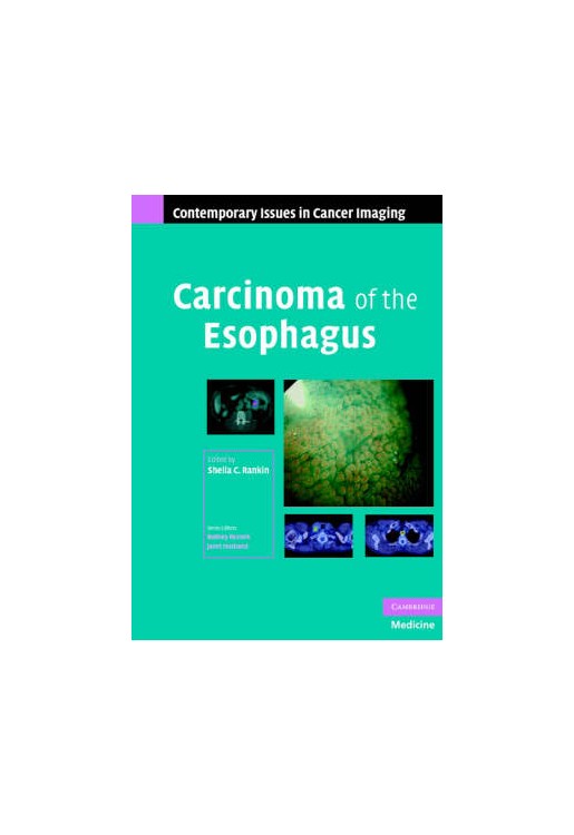 Carcinoma of the Esophagus