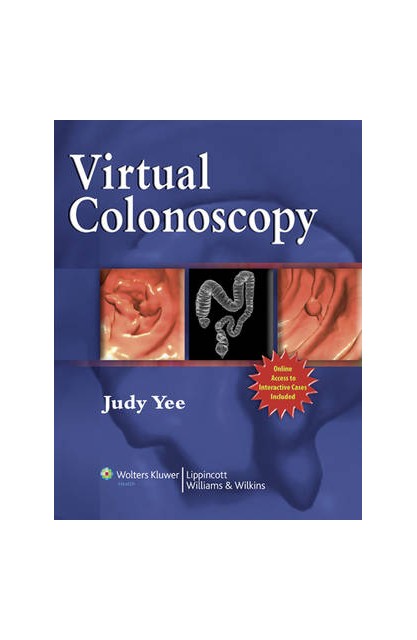 Virtual Colonoscopy