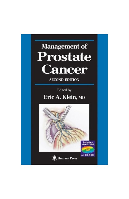 Management of Prostate Cancer
