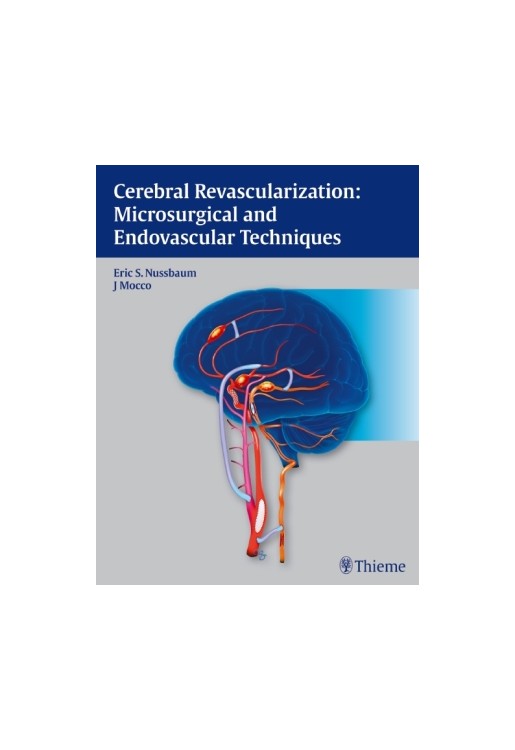 Cerebral Revascularization