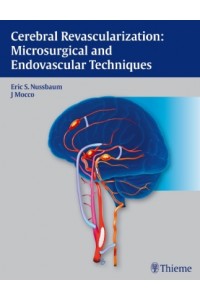 Cerebral Revascularization