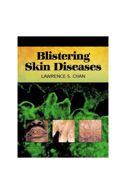 Blistering Skin Diseases