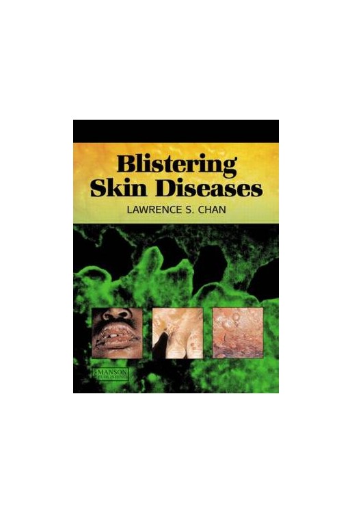Blistering Skin Diseases