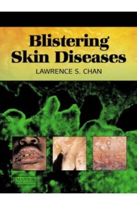 Blistering Skin Diseases