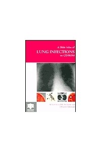 Slide Atlas of Lung Infections on CD