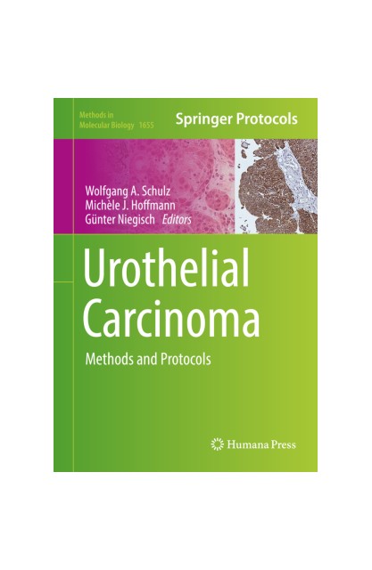 Urothelial Carcinoma