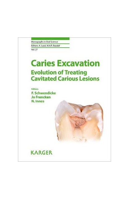 Caries Excavation:...