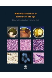 Who Classification of Tumours of the Eye