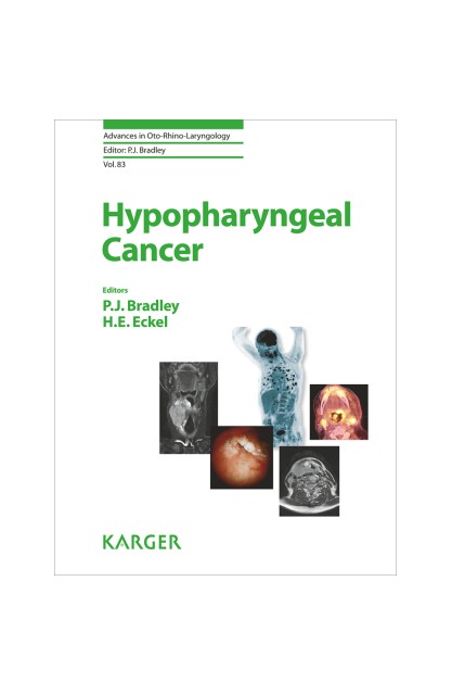 Hypopharyngeal Cancer