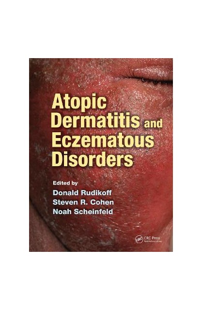 Atopic Dermatitis and...