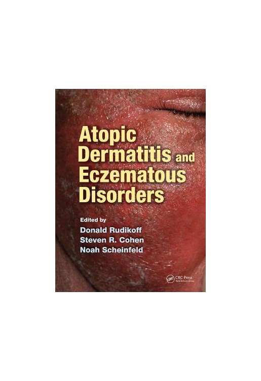Atopic Dermatitis and Eczematous Disorders