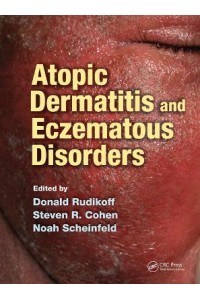 Atopic Dermatitis and Eczematous Disorders