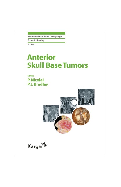 Anterior Skull Base Tumors