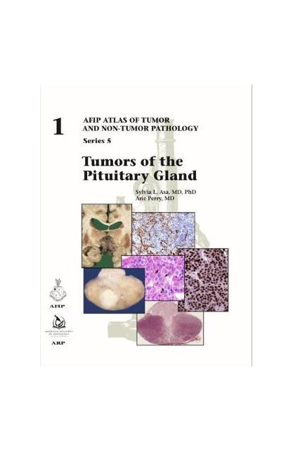 Tumors of the Pituitary Gland
