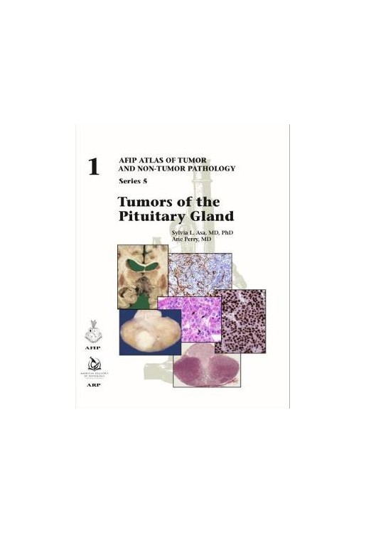 Tumors of the Pituitary Gland