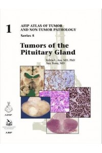 Tumors of the Pituitary Gland
