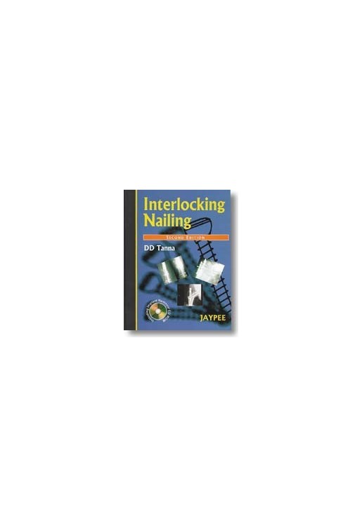 Interlocking Nailing 2E