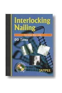 Interlocking Nailing 2E